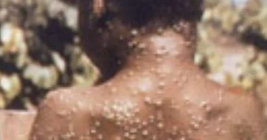 - This Nation monkeypox